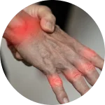 Tendinite | Dr. Eduardo Medeiros - Ortopedista
